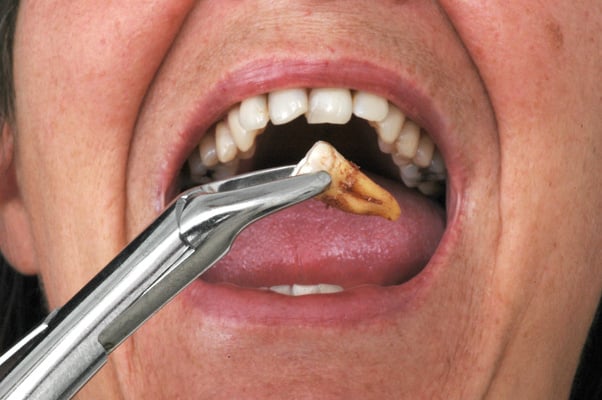 Tooth Extraction