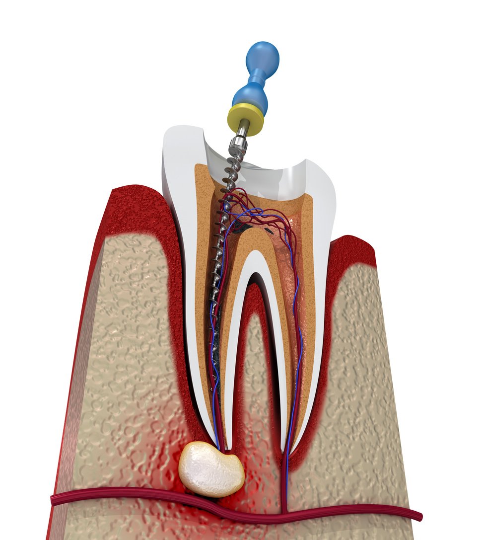 Root canal treatment process. 3D illustration