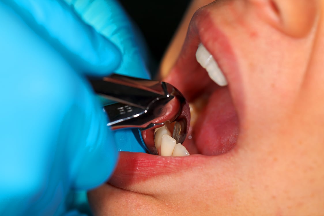 Dental extraction