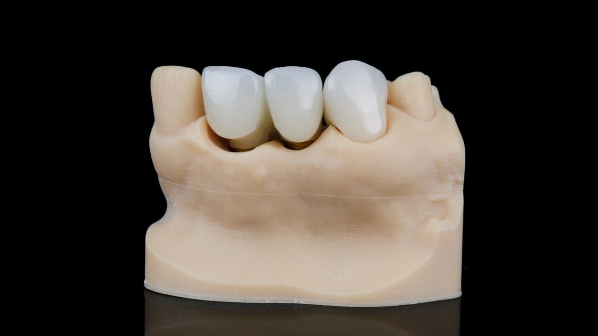 Dental Crown of High Quality and Accuracy on the Dental Model, S