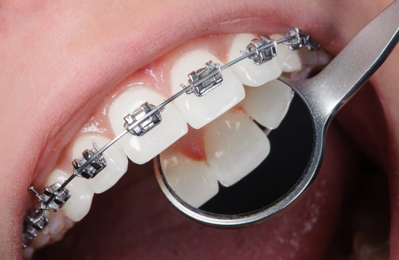 Close-up dental braces on teeth. Orthodontic Treatment