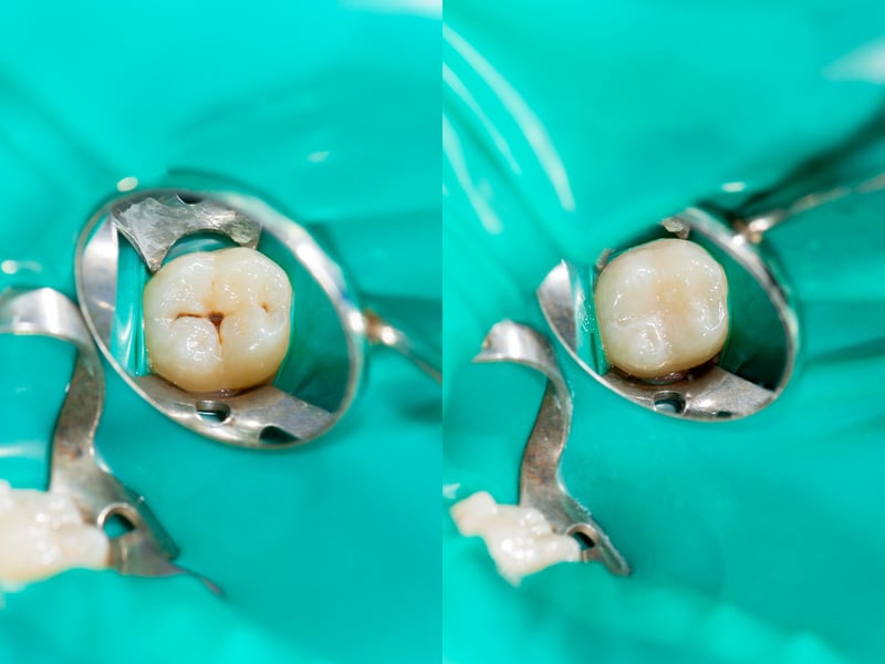 Dental caries. Filling with dental composite photopolymer material using rabbders. The concept of dental treatment in a dental clinic